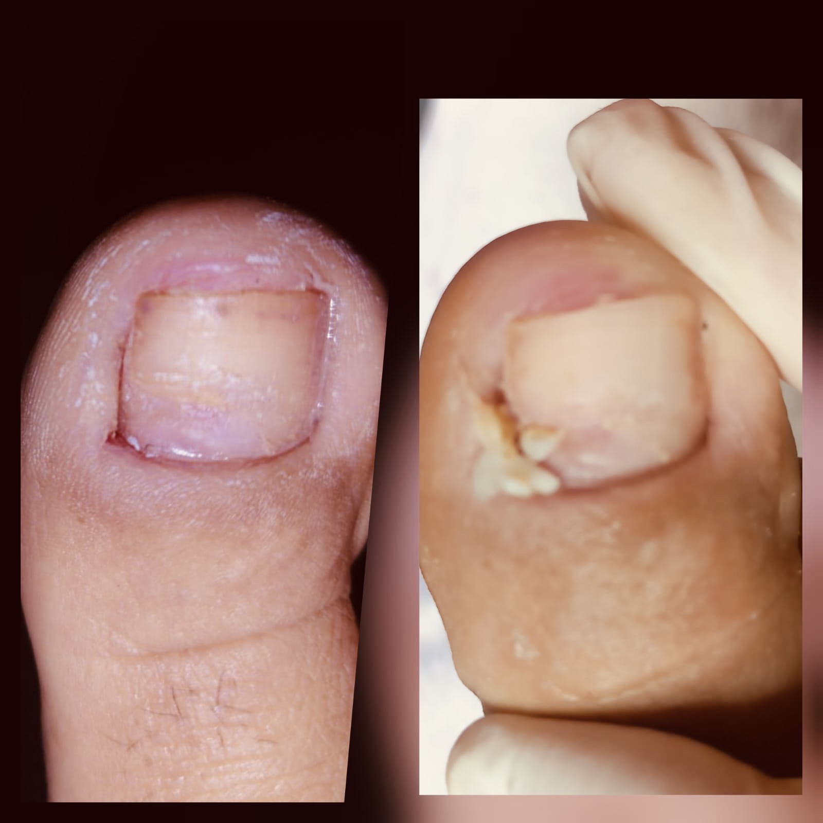 Antes e depois de tratamento clínico completo de podologia na AC Estética e Podologia em Avaré.