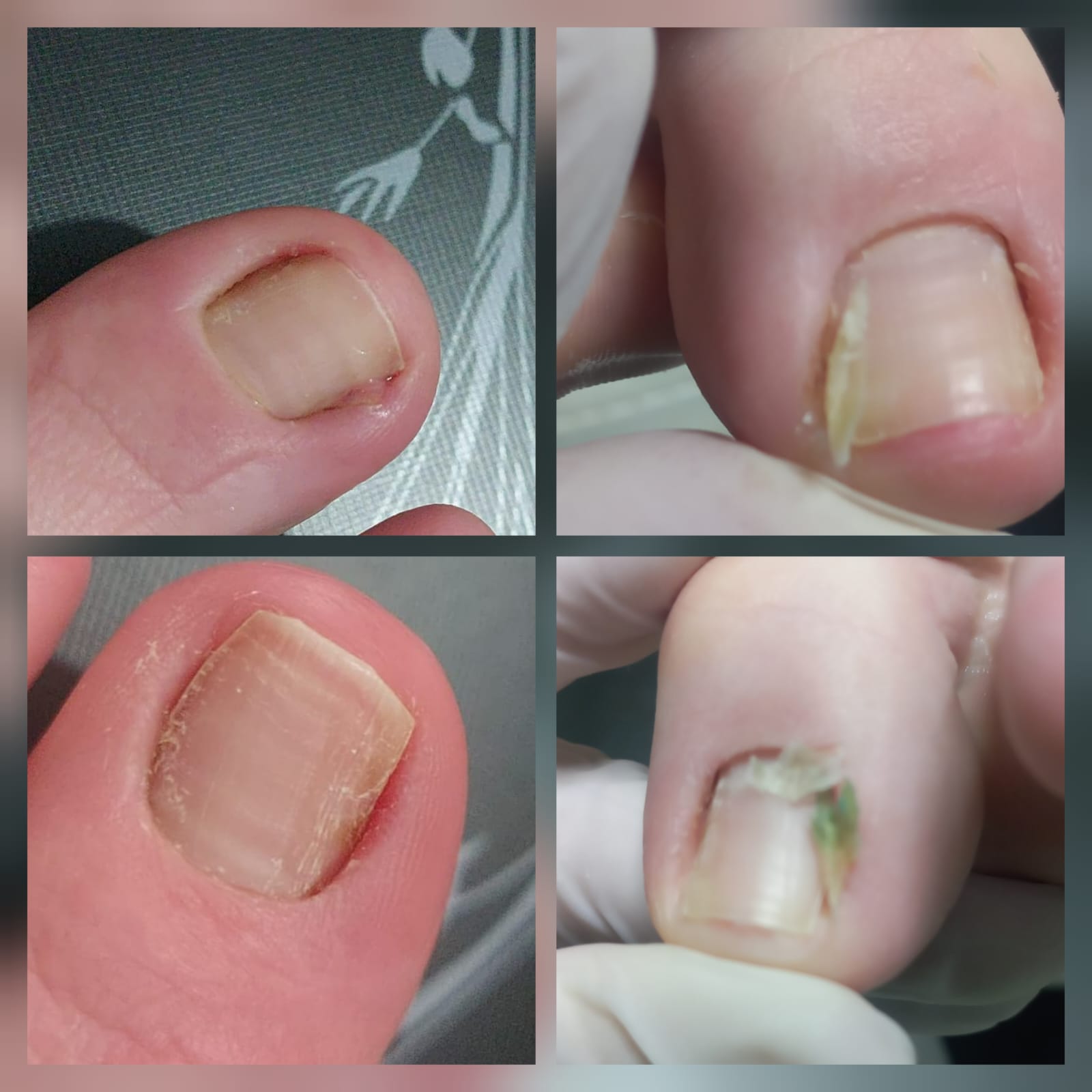 Antes e depois de casos variados de podologia clínica na AC Estética e Podologia em Avaré.